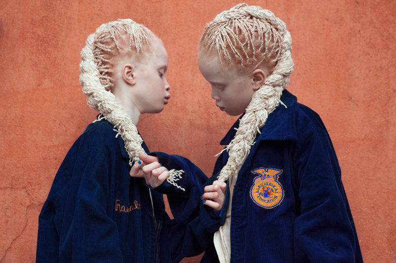 bawar albino twins